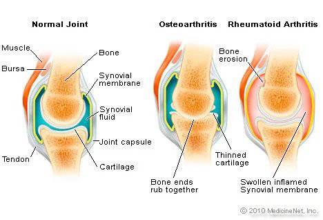 REUMATOIDNI ARTRITIS (RA)